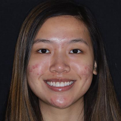 Minimal Prep Porcelain Veneers Maggie - After