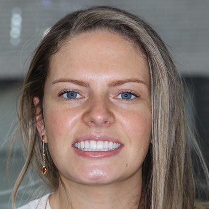 Minimal Prep Porcelain Veneers Jennifer - After