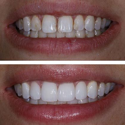 Minimal Prep Porcelain Veneers Jennifer - Before