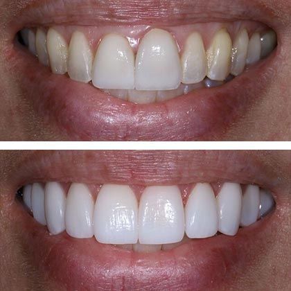 Minimal Prep Porcelain Veneers Carmen - Before