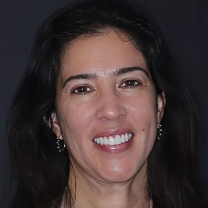 Minimal Prep Porcelain Veneers Carmen - After