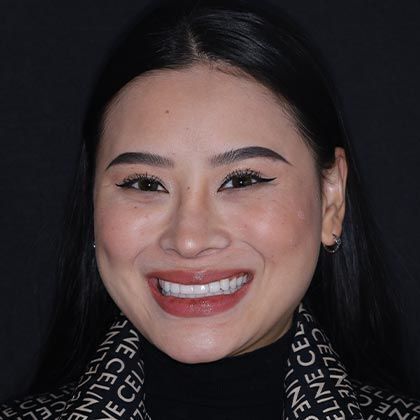 Minimal Prep Porcelain Veneers Hilary - After