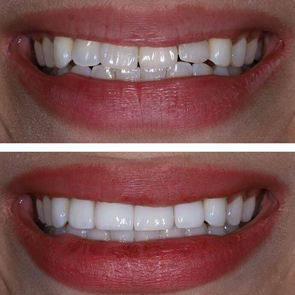 Minimal Prep Porcelain Veneers Hilary - Before