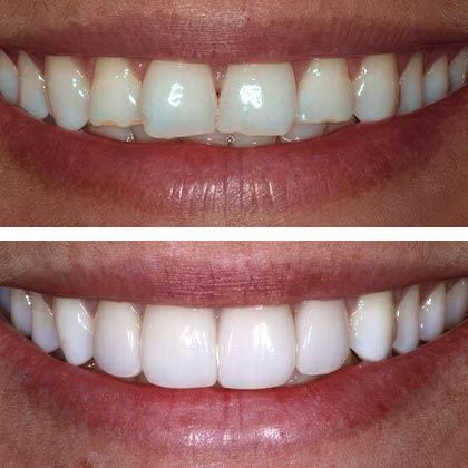 Minimal Prep Porcelain Veneers Stephanie - Before