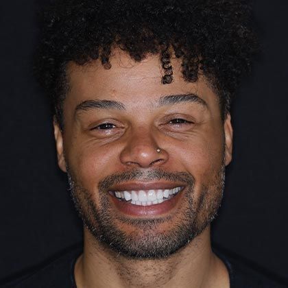 Minimal Prep Porcelain Veneers Robert - After