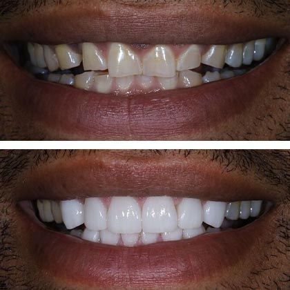 Minimal Prep Porcelain Veneers Robert - Before