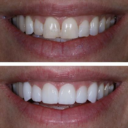 Minimal Prep Porcelain Veneers Philippa - Before