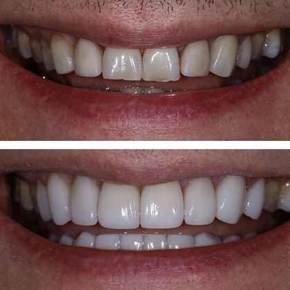 Minimal Prep Porcelain Veneers Thomas - Before