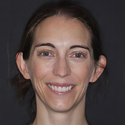 Minimal Prep Porcelain Veneers Nicole  - After