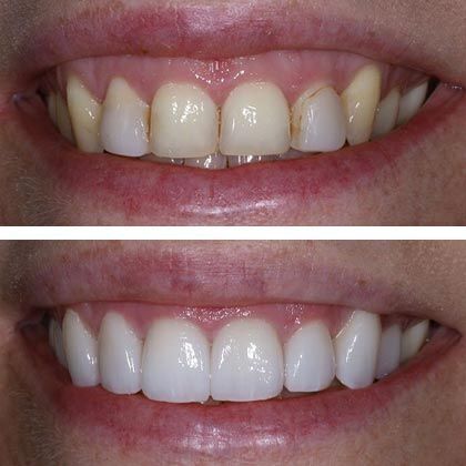 Minimal Prep Porcelain Veneers Nicole  - Before