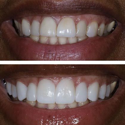 Minimal Prep Porcelain Veneers Roxanne - Before