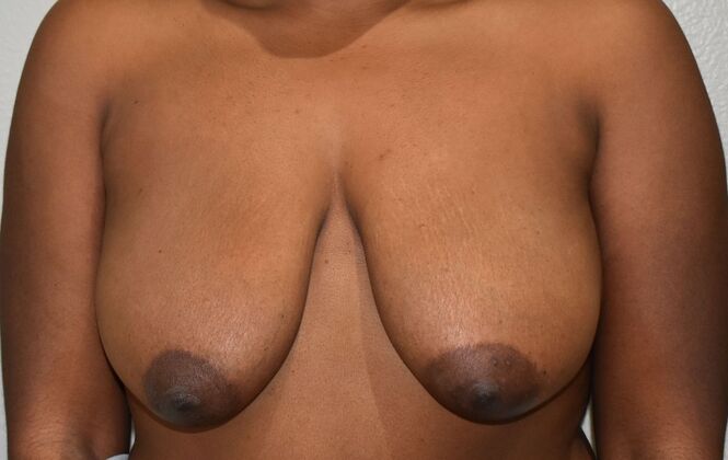 Breast Lift (Mastopexy) Case 202 - Before