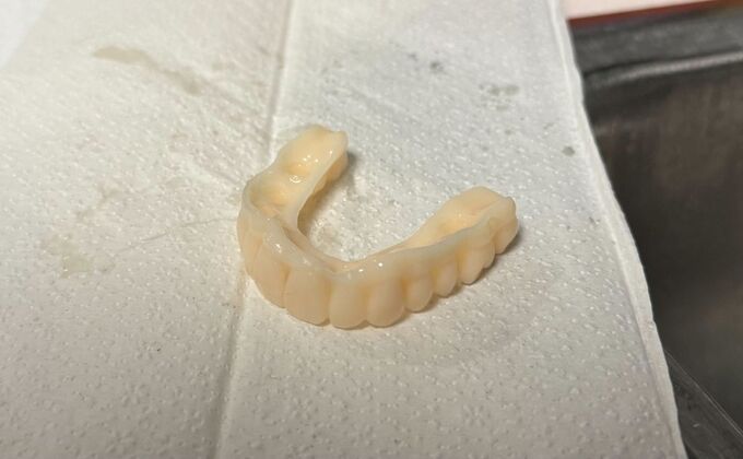 Dental Implants: Maxillary Full Arch Hybrid Bridge - Before