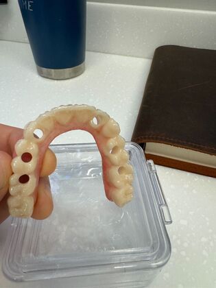 Dental Implants: Maxillary Full Arch Hybrid Bridge - Before