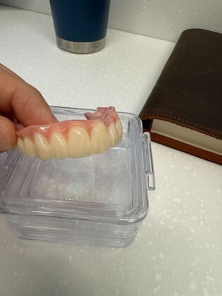 Dental Implants: Maxillary Full Arch Hybrid Bridge - Before