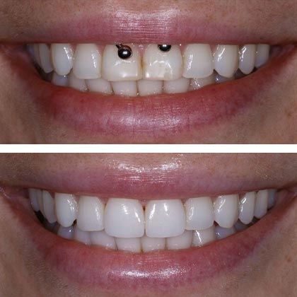 Minimal Prep Porcelain Veneers Anastasiya - Before