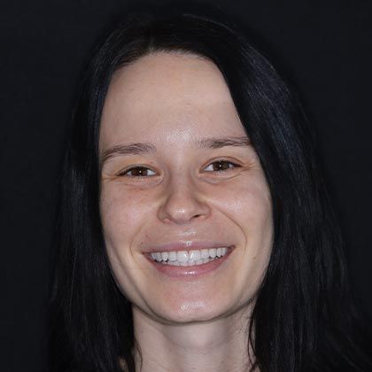 Minimal Prep Porcelain Veneers Anastasiya - After