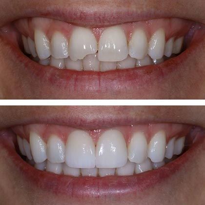 Minimal Prep Porcelain Veneers Michele S - Before