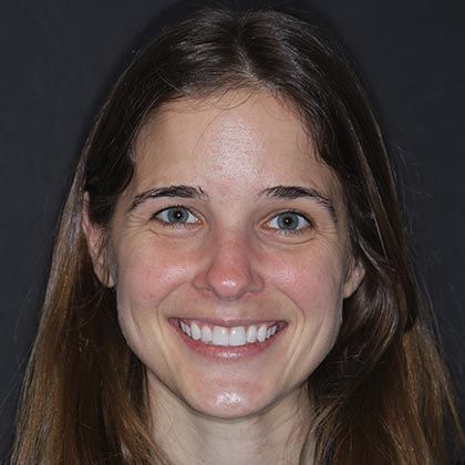 Minimal Prep Porcelain Veneers Michele S - After