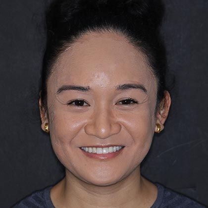 Minimal Prep Porcelain Veneers Ana-Clarita - After