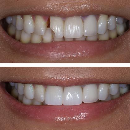 Minimal Prep Porcelain Veneers Ana-Clarita - Before