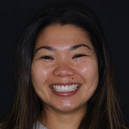 Minimal Prep Porcelain Veneers Daphne - After