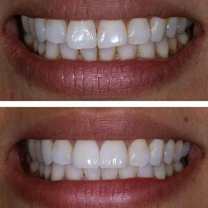 Minimal Prep Porcelain Veneers Daphne - Before