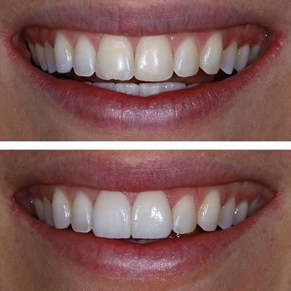 Minimal Prep Porcelain Veneers Sydney - Before