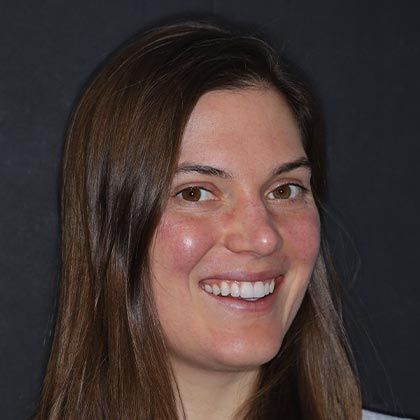 Minimal Prep Porcelain Veneers Sydney - After