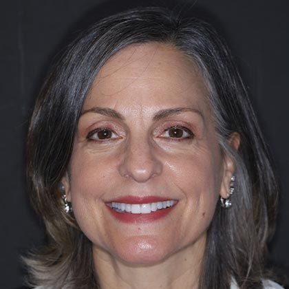 Minimal Prep Porcelain Veneers Michele P - After