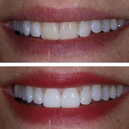 Minimal Prep Porcelain Veneers Michele P - Before