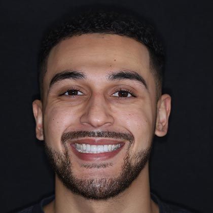 Minimal Prep Porcelain Veneers Scott - After