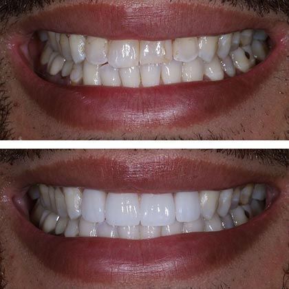 Minimal Prep Porcelain Veneers Scott - Before