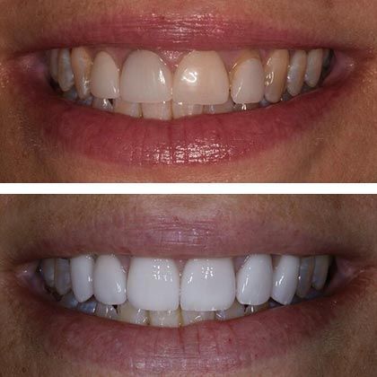 Minimal Prep Porcelain Veneers Sheryl - Before