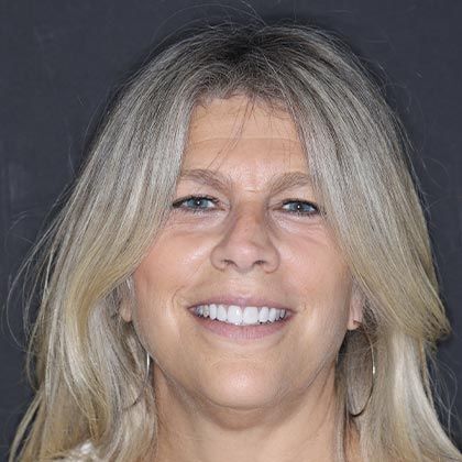 Minimal Prep Porcelain Veneers Sheryl - After