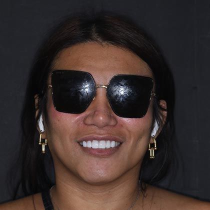 Minimal Prep Porcelain Veneers Florian - After