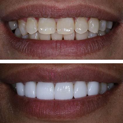 Minimal Prep Porcelain Veneers Florian - Before