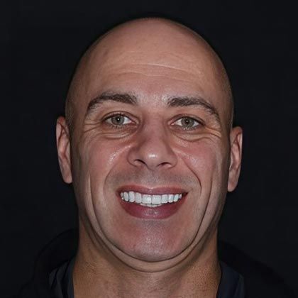 Minimal Prep Porcelain Veneers Michael - After