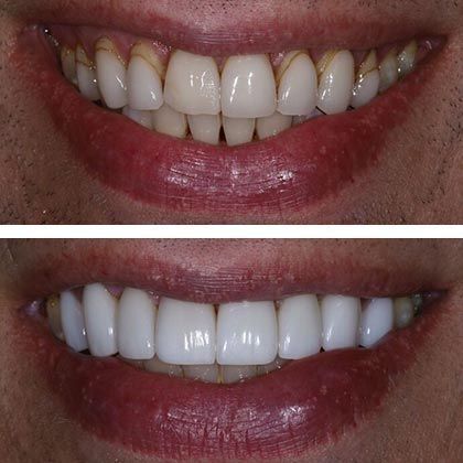 Minimal Prep Porcelain Veneers Michael - Before