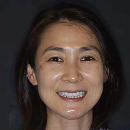 Minimal Prep Porcelain Veneers Yoko - After