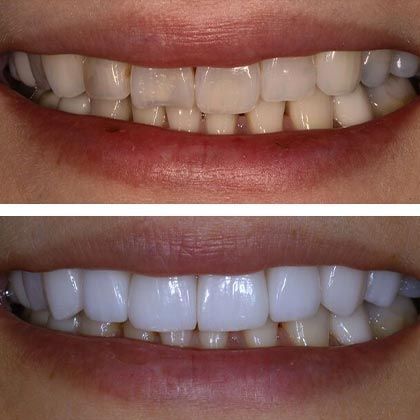 Minimal Prep Porcelain Veneers Yoko - Before