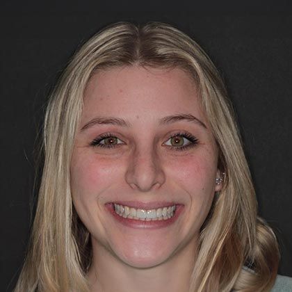 Minimal Prep Porcelain Veneers Alison - After