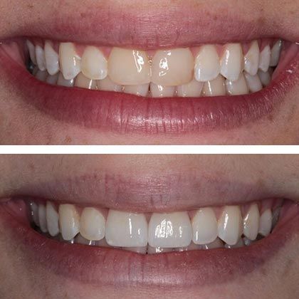 Minimal Prep Porcelain Veneers Alison - Before