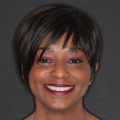 Minimal Prep Porcelain Veneers Andrea - After