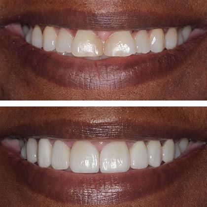 Minimal Prep Porcelain Veneers Andrea - Before
