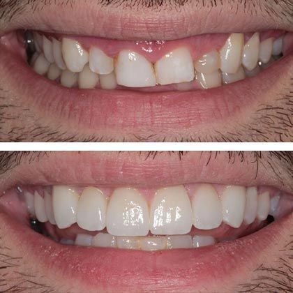 Minimal Prep Porcelain Veneers Camryn - Before