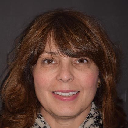 Minimal Prep Porcelain Veneers Veronique - After