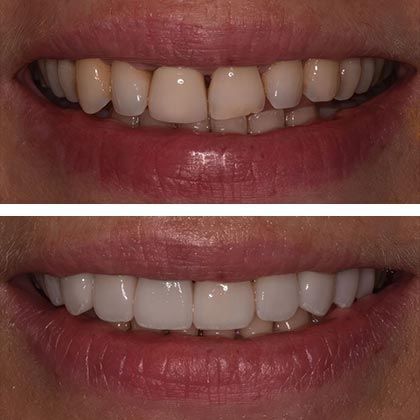 Minimal Prep Porcelain Veneers Veronique - Before