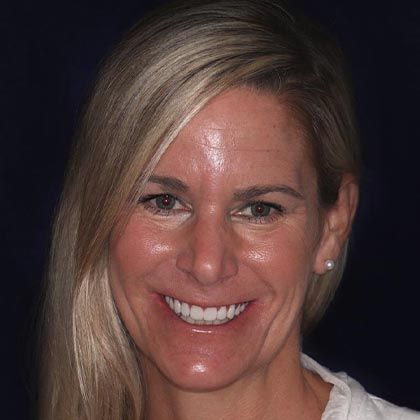 Full Mouth Rehabilitation Nicole - After