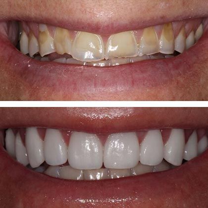 Full Mouth Rehabilitation Nicole - Before